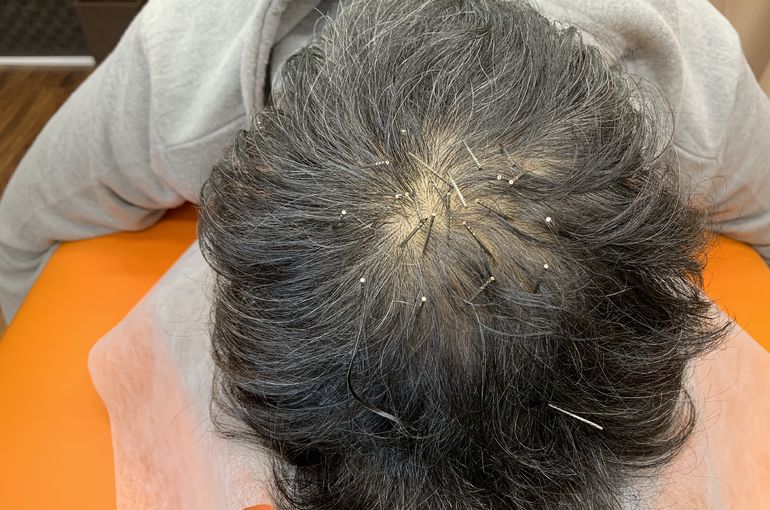 高崎で薄毛にははり治療がおすすめ 高崎のowl鍼灸整骨院は肩こりや腰痛を軽減する施術を行っています