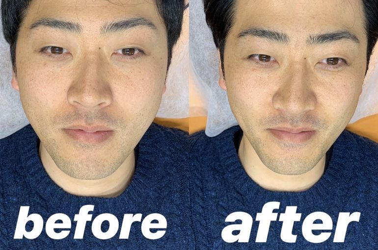 高崎で顔のしわやたるみを改善リフトアップモニターを鍼灸整骨院で募集